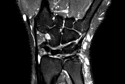 Wrist Off Center Imaging Philips Mr Body Map