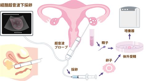 体外受精･顕微授精│とまこまいレディースクリニック