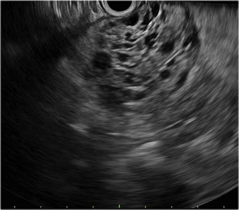 Endoscopic ultrasound. An anechoic, multicystic, septated and shadowing ...