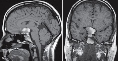 Intracranial Cysts And Cyst Like Lesions Radiology Key