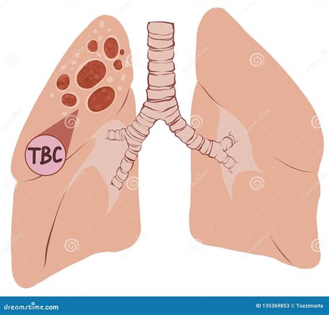 Tuberculosis Enfermedad Pulmonar Imagen De Archivo Ilustraci N De