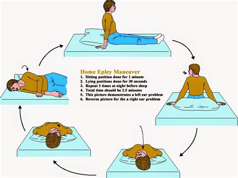 Epley Maneuver Diagram For Patients