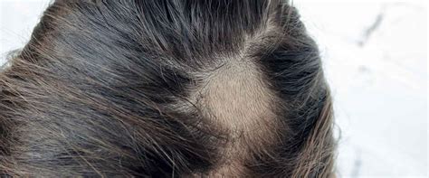 Sa K Ran Alopesi Areata Nedir Sa K Ran Belirtileri Ve Tedavi