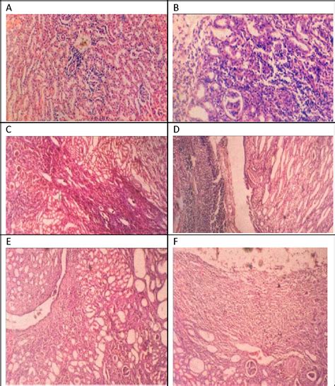 Figure From Histological Findings Of Ascending Urinary Tract