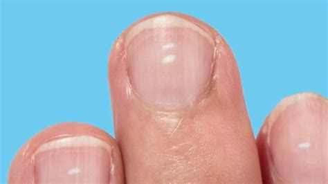 Leukonychia White Spots On Nails