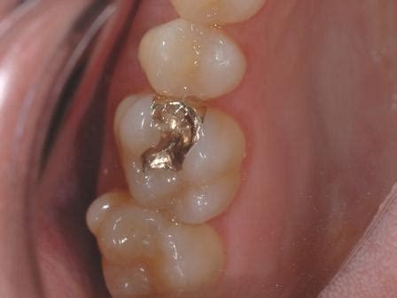 Gold Fillings Brisbane | Nundah Village Dental