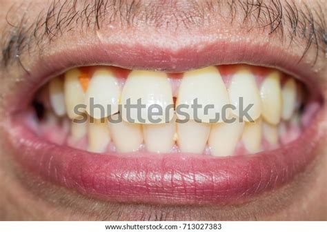 Asian Men Have Teeth Dirty Unclean Stock Photo Shutterstock