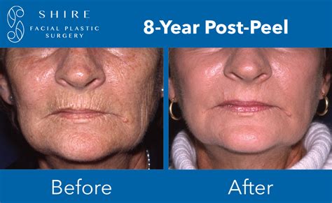 Deep Chemical Peels Before After Shire Facial Plastic Surgery