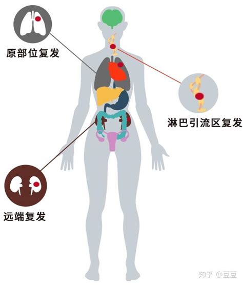 如何正确认识肿瘤的复发和转移 知乎