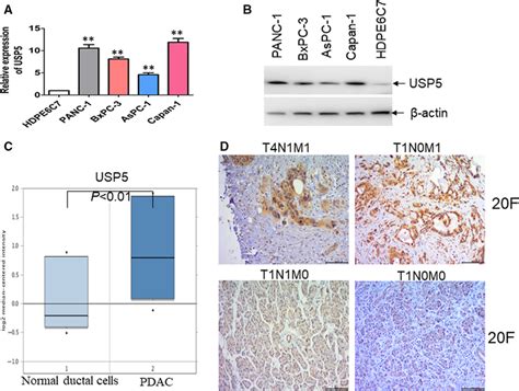 Usp Is Associated With Metastasis In Pdac Patients A And B The Mrna