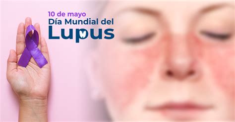 D A Mundial Del Lupus De Mayo Instituto De Salud Para El