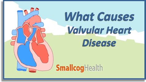 What Causes Valvular Heart Disease Youtube