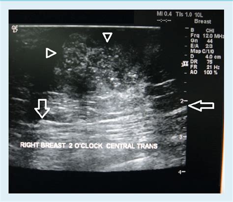 Ultrasound Of The Same Patient Longitudinal Right Sonogram Shows Solid