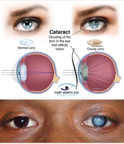 Neuro Vision Flashcards Quizlet