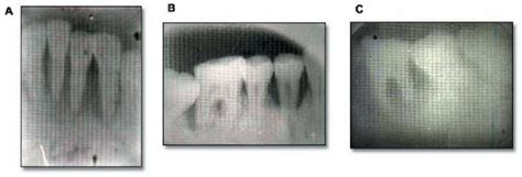 B Postoperative Periapical Radiographs Of Teeth With Alveolar Bone