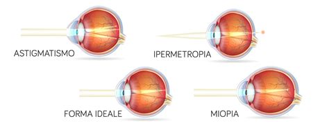 Difetti Di Refrazione Studio Oculistico Babino