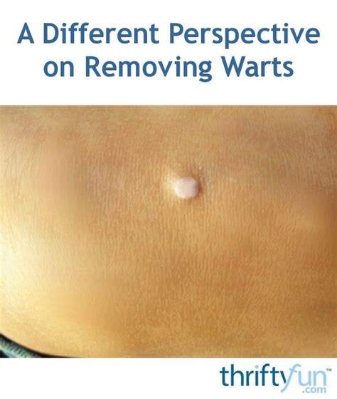 A Different Perspective On Wart Removal | ThriftyFun