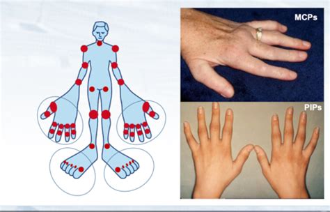 3 Rheumatoid Arthritis Flashcards Quizlet