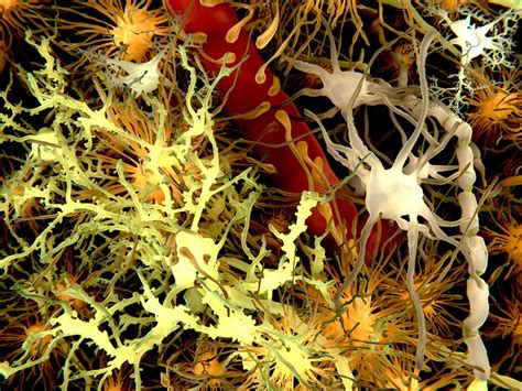 Glial cells may play key role in Huntington’s disease - Neuro Central