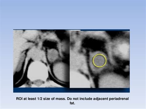 Adrenal Gland Tumors Radiology