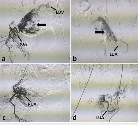 Dsa Images Of The Patient With Avm A B Pre Embolization Dsa Images