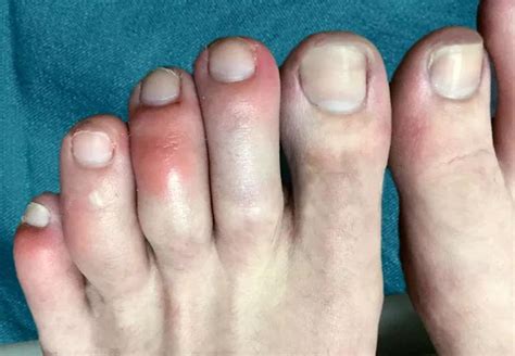 Covid Toes And Rashes What To Know