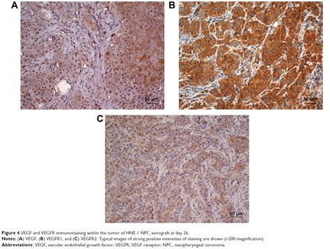 Efficacy Of BIBF 1120 Or BIBF 1120 Plus Chemotherapy On Nasopharyngeal