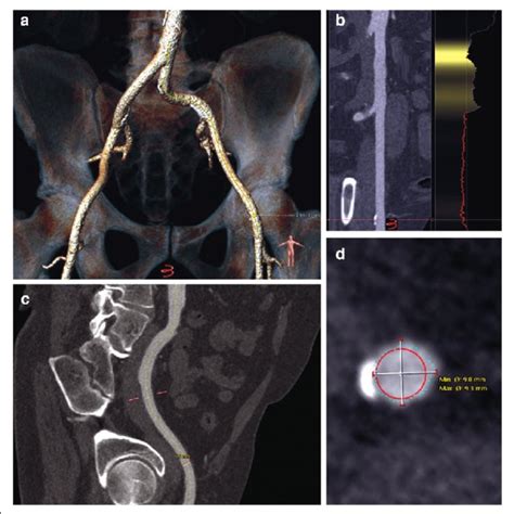 Preoperative Computed Tomography Angiography Scans And Reconstructions