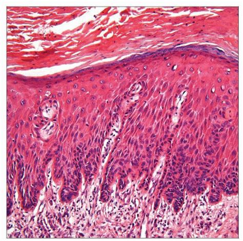 Penile Intraepithelial Neoplasia (PeIN) | Basicmedical Key