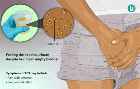 Symptoms, Causes, Treatment of Urinary Tract Infection (UTI) – Health ...