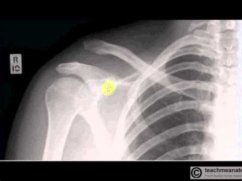 Interpreting X-Rays of the Shoulder Joint - YouTube