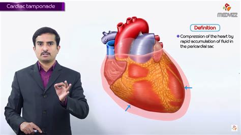 Cardiac Tamponade Ecg