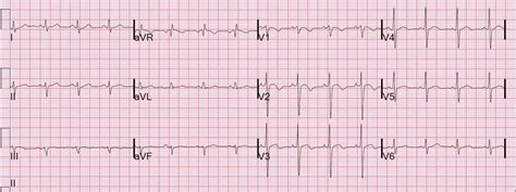 Dr Smith S Ecg Blog Chest Pain Sob Anterior T Wave Inversion Positive Troponin