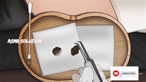 Huge Navel Stone Removal Asmr Treatment Animation Asmr Shorts Navel