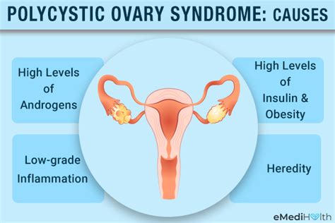 Pcod And Pcos Causes Symptoms Differences And Treatment Off