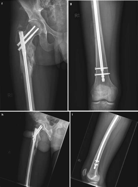 Subtrochanteric Fractures Musculoskeletal Key