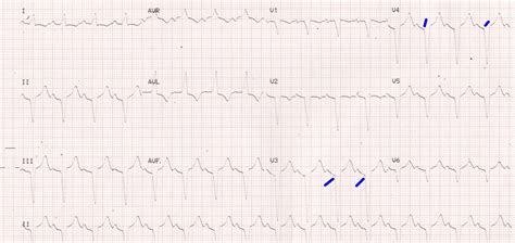 AV sequential pacing (tracking) – All About Cardiovascular System and ...