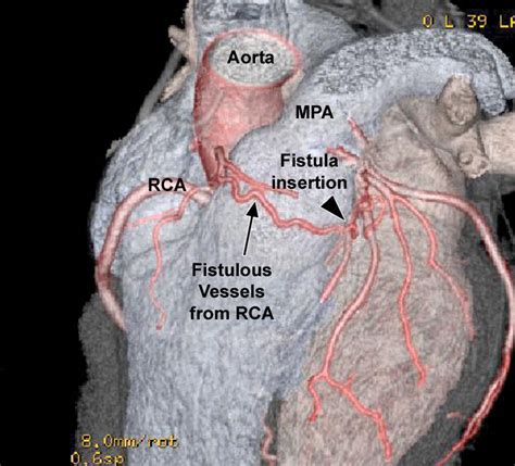 Coronary Artery Fistulas CT Findings RadioGraphics