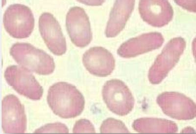 Anaemia and Red Cell Morphology | Quiz