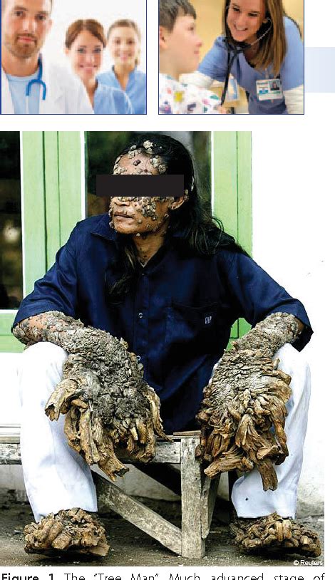 Figure 1 From Epidermodysplasia Verruciformis Symptoms Causes