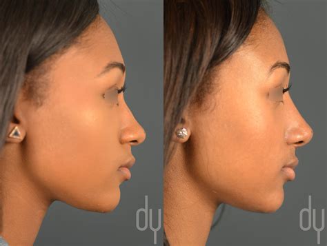 Primary Rhinoplasty Before And After Beverly Hills Facial Plastic