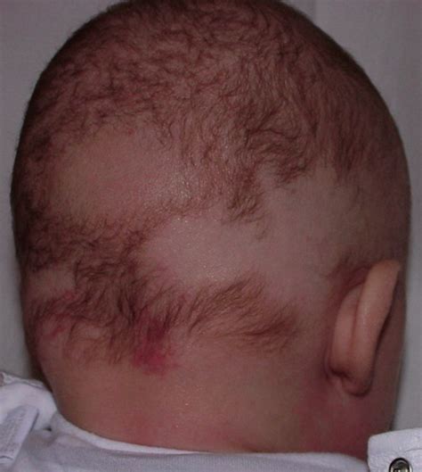 —neonatal Alopecia Areata Is Not So Rare Download Scientific Diagram