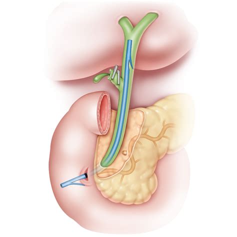 Ercp Stent