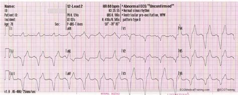 Wolff Parkinson White Wpw Syndrome Type B St Emlyn S Off