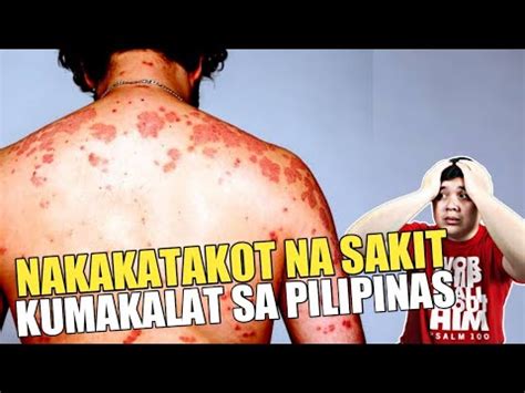 Nakakatakot Na SAKIT Kumakalat Sa PILIPINAS YouTube