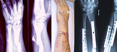 Closed Fracture Treatment | Closed Bone Fracture Surgery