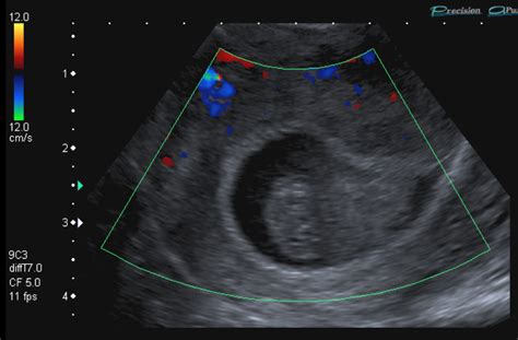 Transvaginal Ultrasound Scan Showing Non Viable Intrauterine Gestation