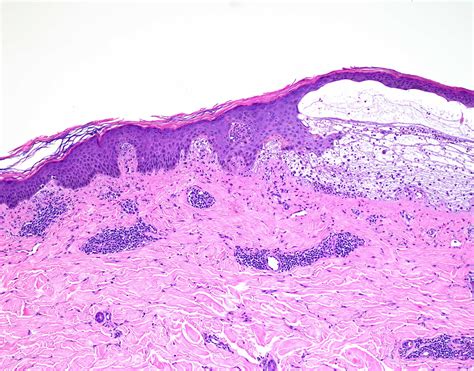 Dermatitis Herpetiformis Histology