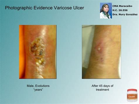 Varicose Ulcer Evidence - Part II - Circulat