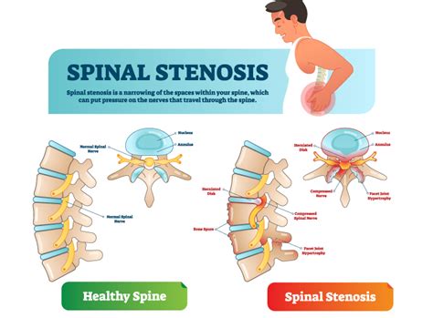 What is Spinal Stenosis? - Orthopedic & Sports Medicine